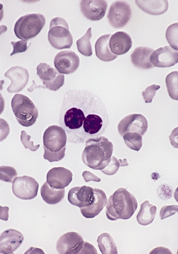 Hypogranular neutrophil with a pseudo-Pelger-Huet nucleus in MDS.jpg