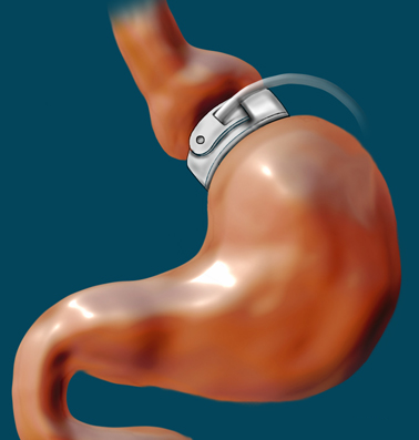 Adjustable Gastric Band.png