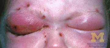 Orbital cellulitis.jpg