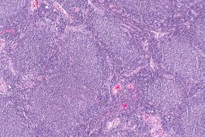 Follicular lymphoma -- low mag.jpg