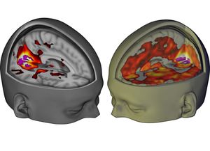 This image shows how much more of the brain contributes to the visual experience under LSD than under placebo.jpg