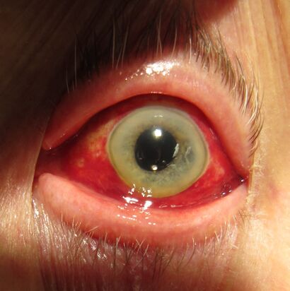 Human eye showing subconjunctival hemorrhage.jpg