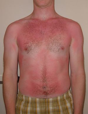 Sunburn.jpg