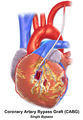 Illustration of Single bypass