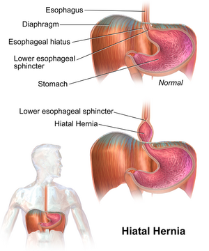 Hiatal Hernia.png