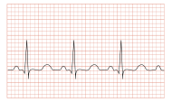 Tachycardia ECG paper.svg