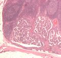 Micrograph of metastatic papillary thyroid carcinoma to a lymph node. H&E stain.