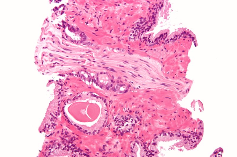 ملف:Prostatic adenocarcinoma with perineural invasion.JPG