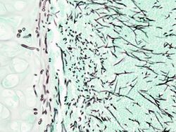 Pulmonary aspergillosis (1) invasive type.jpg