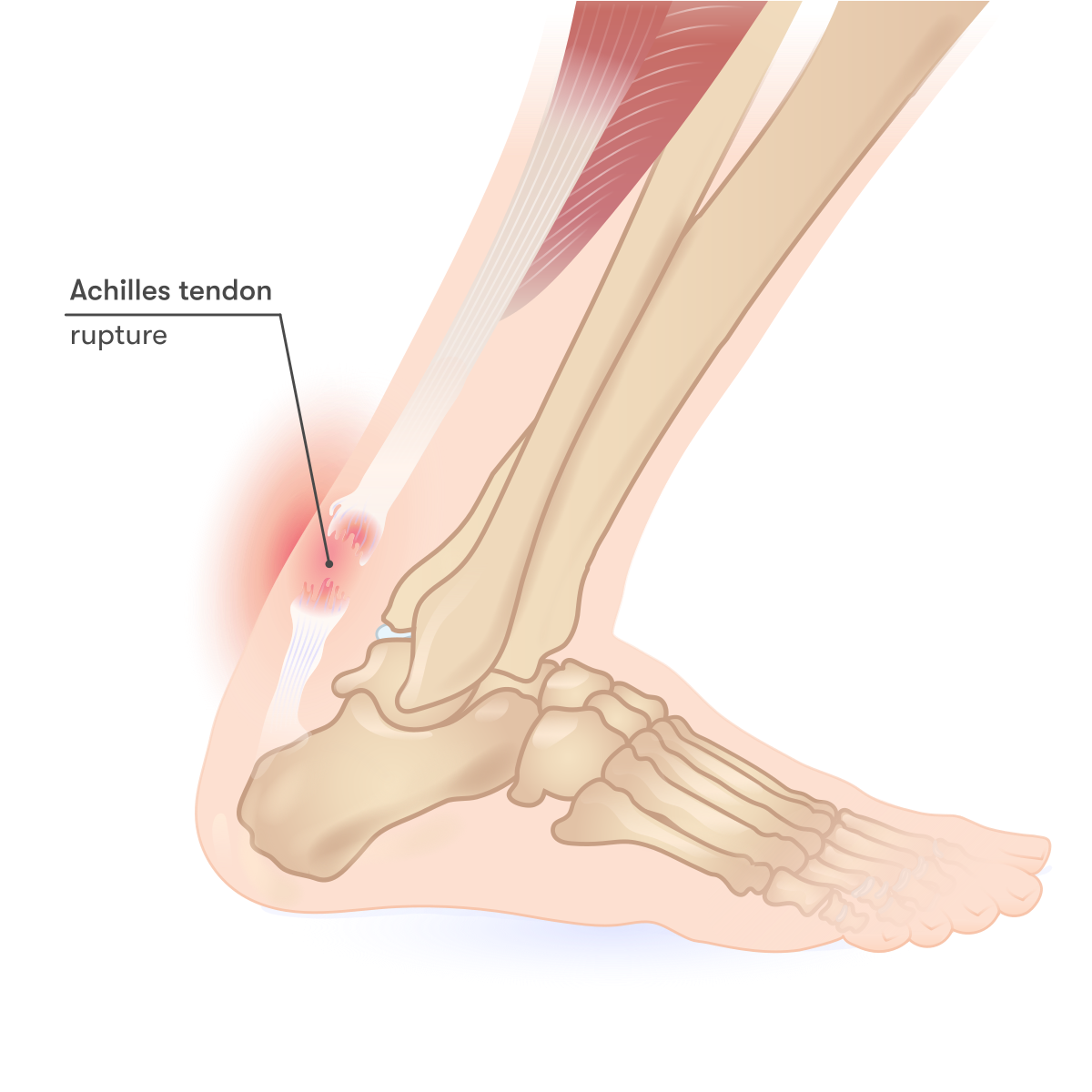 achilles-tendon-rupture-svg