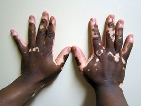 Vitiligo2.JPG