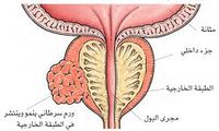 رسم يوضح انتشار سرطان الپروستاتا.