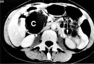 Large pancreatic cyst causing symptoms of early satiety.jpg