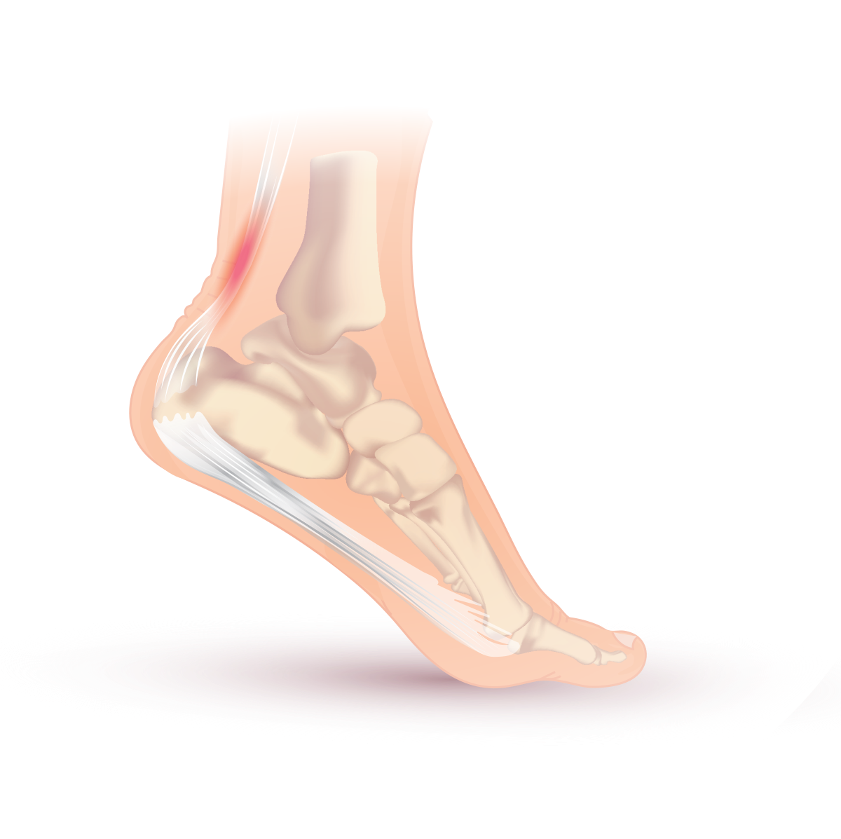 achilles-tendonitis-svg