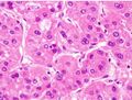 Moderately differentiated HCC.