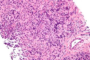 Primary mediastinal large B-cell lymphoma - high mag.jpg