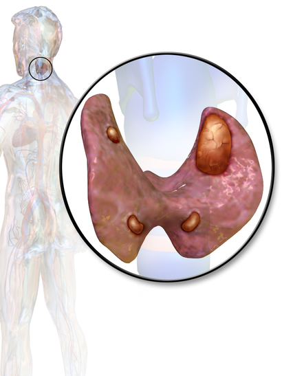 Blausen 0533 Parathyroid adenoma.png