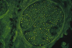 HIV-induced autoimmun-antiMyelin Antibodies against human nerve tissue (FITC-Stain).jpg