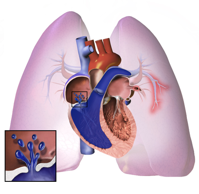 Pulmonary Hypertension.png