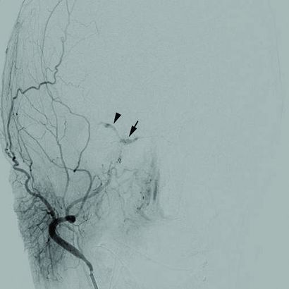 1471-2415-12-28-1Cerebral angiogram.jpg