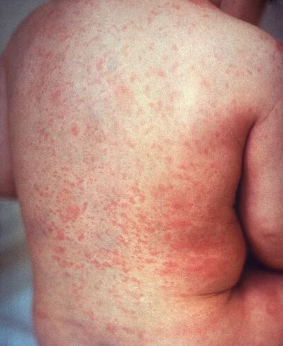 Rash of rubella on back (crop).JPG