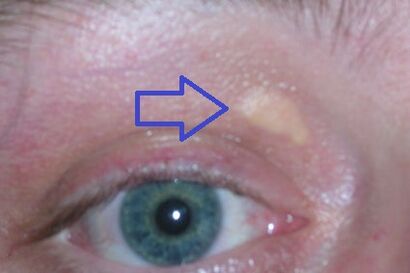 Xanthelasma palpebrarum.jpg