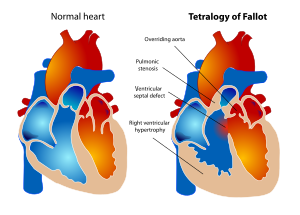 Tetralogy of Fallot.svg