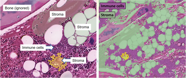 Tissue segmentation for digital calculation of bone marrow cellularity in QuPath: The system is trained on the appearance of immune cells versus other tissue, and uses this to give an overall percentage of each type.