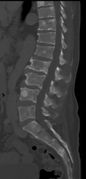 CT scan of the lower vertebral column in a man with multiple myeloma, showing multiple osteoblastic lesions. These are more radiodense (brighter in this image) than the surrounding cancellous bone, in contrast to osteolytic lesions which are less radiodense.