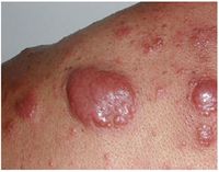 Non-Hodgkin's Lymphoma1.jpg