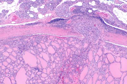 Follicular thyroid carcinoma 2 -- low mag.jpg