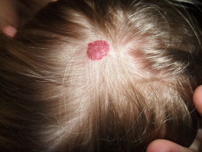 Hemangioma.JPG