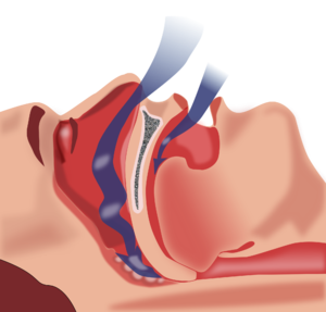 Obstruction ventilation apnée sommeil.png